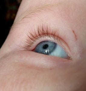 7-15-baby-trichiasis-wimpers-onder-in-het-oog-wimper-snotoogje-irritatie-verhelpen-behandeling-oogarts-olvg-Amsterdam-oorzaak